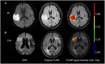 Large vessel occlusion mediated fluid attenuated inversion recovery signal intensity ratio is associated with stroke within 4.5 h